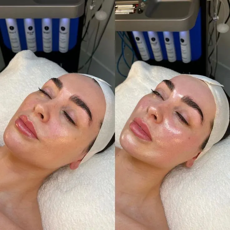 HydraFacial before and after result — House of Aesthetics DHA Phase 6 Lahore