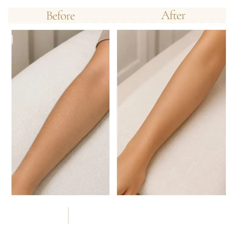 Laser Hair Removal before and after result — House of Aesthetics DHA Phase 6 Lahore