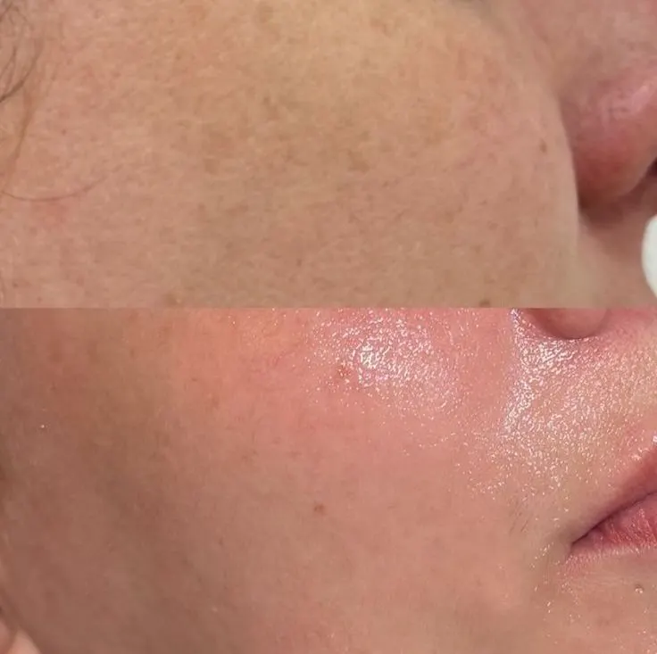 Skin Rejuvenation before and after result — House of Aesthetics DHA Phase 6 Lahore
